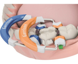Composi-Tight 3D Fusion Teilmatrizensystem